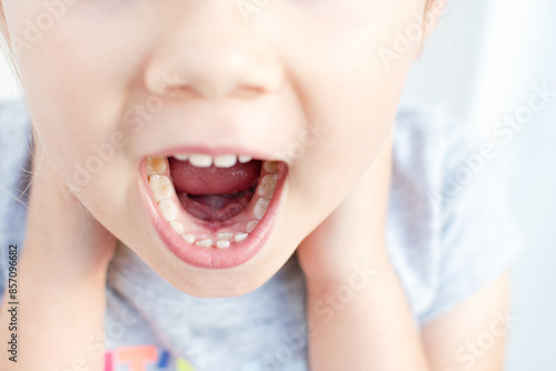 Adult permanent teeth coming in front of the child's baby teeth: shark teeth. Little girl's open mouth.