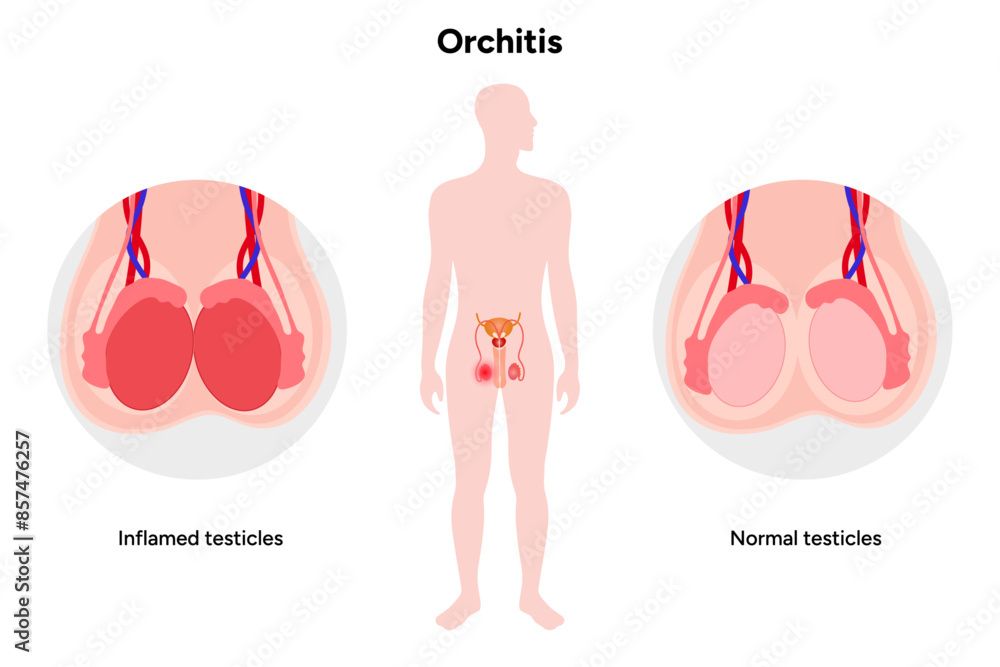 Testitis Male Orchitis Testis Inflamed and normal testicles with man mannequin ...