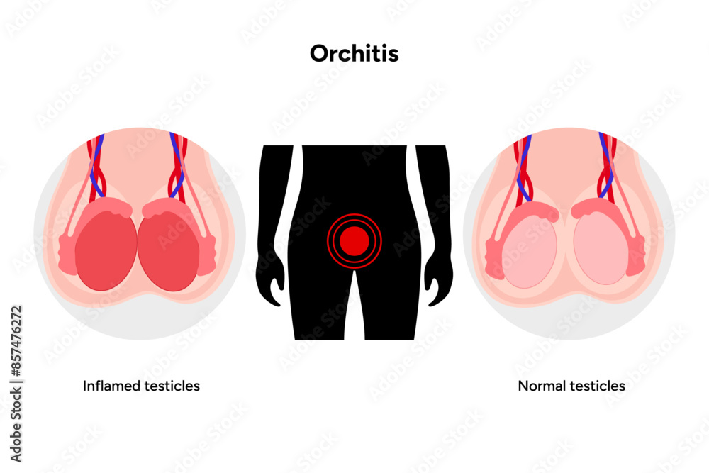 Three Testicles Male Orchitis Testis Inflamed and normal testicles with man mannequin ...