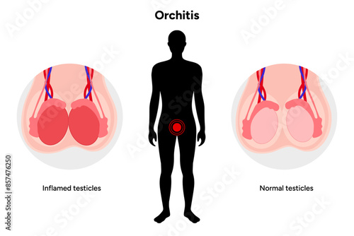 Male Orchitis Testis Inflamed and normal testicles with man mannequin