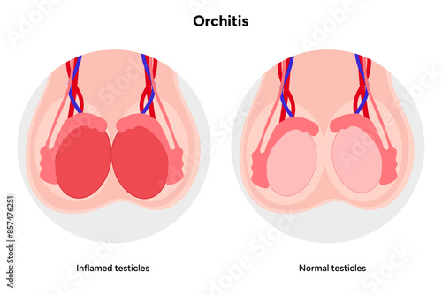 Male Orchitis Testis Inflamed and normal testicles 