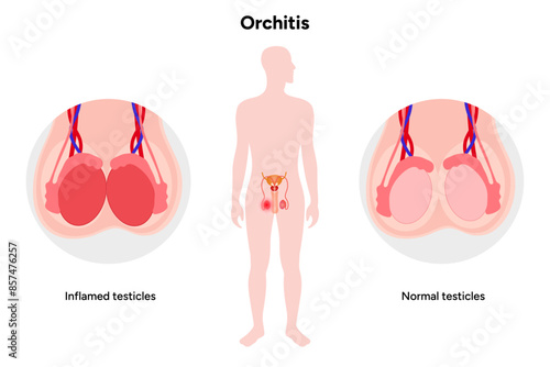 Male Orchitis Testis Inflamed and normal testicles with man mannequin