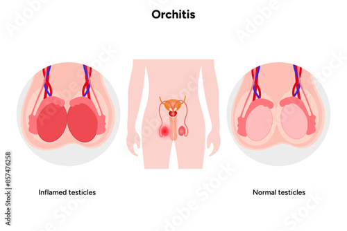 Male Orchitis Testis Inflamed and normal testicles with man mannequin