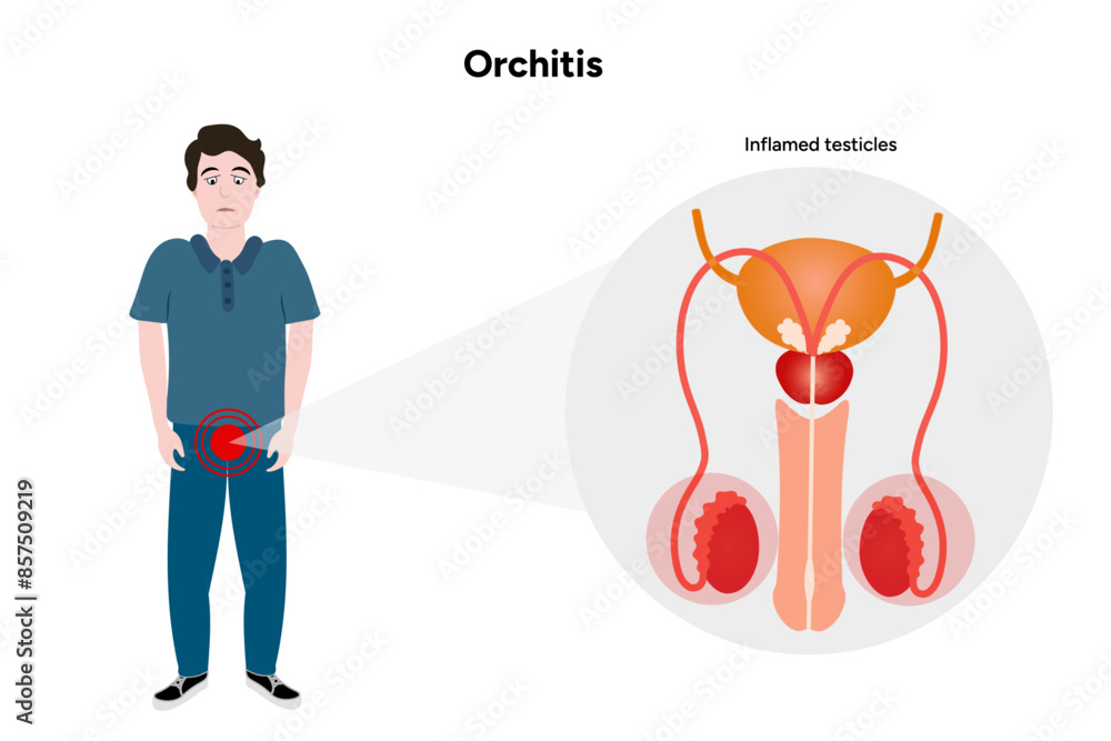 Man with Male reproductive system, Orchitis Testis disease Inflamed ...