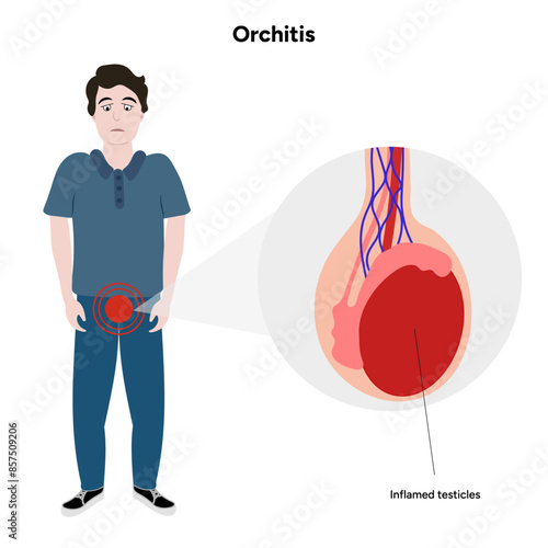 Man with Male Orchitis Testis disease