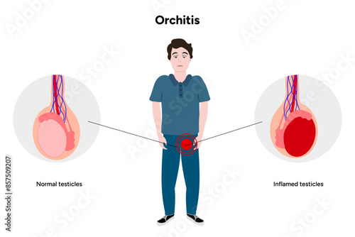 Man with Male Orchitis Testis disease  Inflamed and normal testicles 