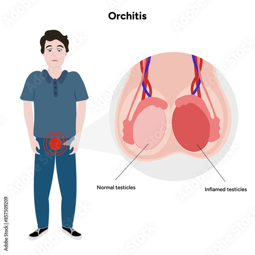 Man with Male Orchitis Testis disease  Inflamed and normal testicles 