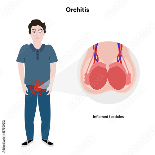 Man with Male Orchitis Testis disease  Inflamed and normal testicles 