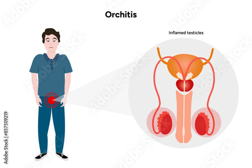 Man with Male reproductive system, Orchitis Testis disease  Inflamed 