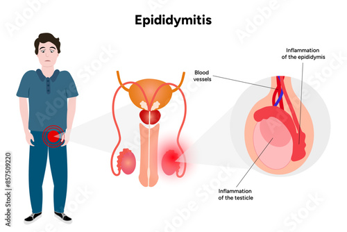 Epididymitis disease of testicles with man illustration