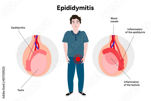 Epididymitis disease of testicles with man illustration
