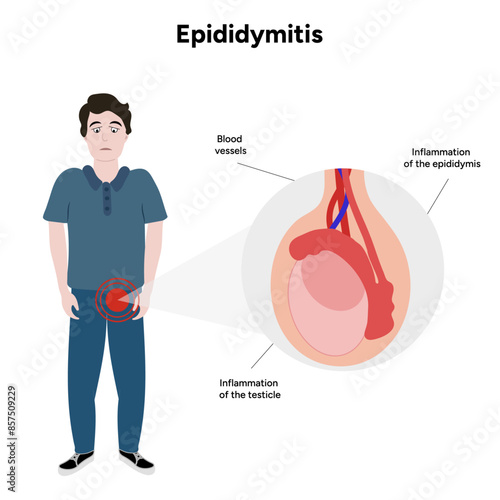 Epididymitis disease of testicles with man illustration