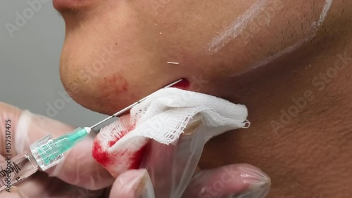 Jawline filler procedure for male patient. Injecting filler gel or hyaluronic acid for a more square jaw look. Done at a esthetic clinic.