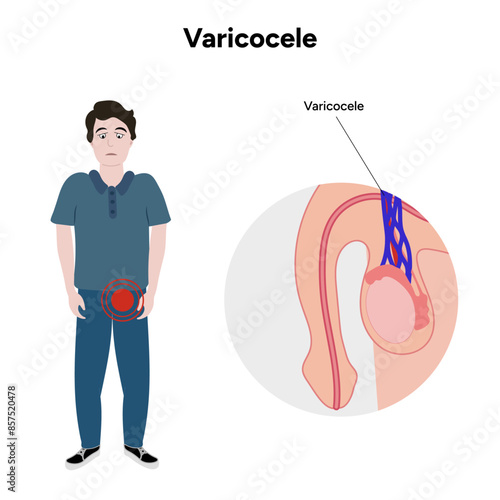 Varicocele male disease 