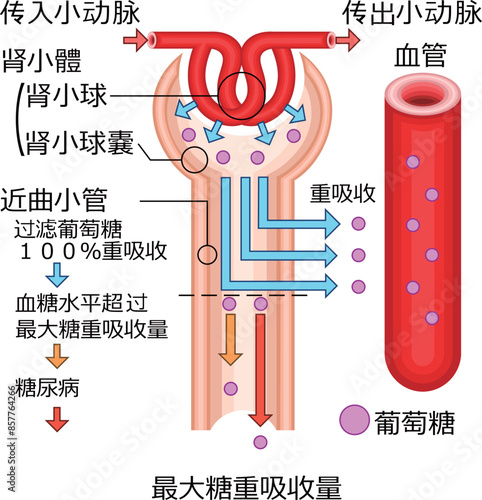 腎小体　糖尿　イラスト　中国語 photo