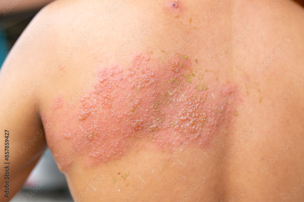 custom made wallpaper toronto digitalShingles occurs on the body.Herpes zoster 