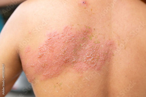 Wallpaper Mural Shingles occurs on the body.Herpes zoster  Torontodigital.ca