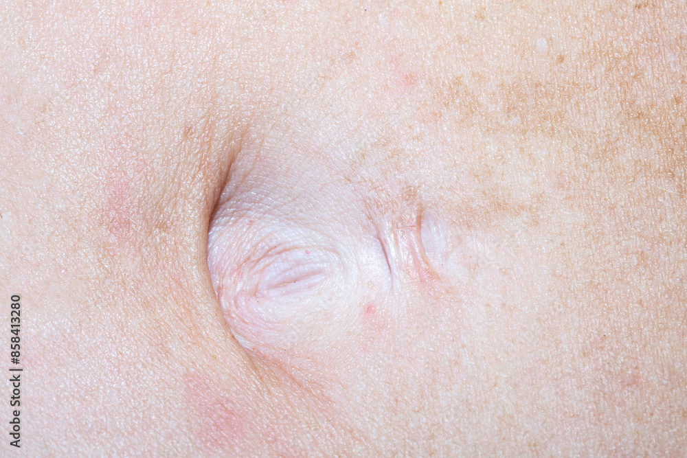 Fototapeta premium Details of the piercing hole above the navel