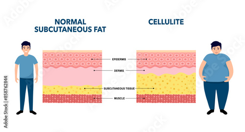 Cellulite concept, excess fat in human body. Overweight and increase subcutaneous fat diagram. Obese people, diet program. Skin layers structure epidermis, dermis and hypodermis vector illustration.