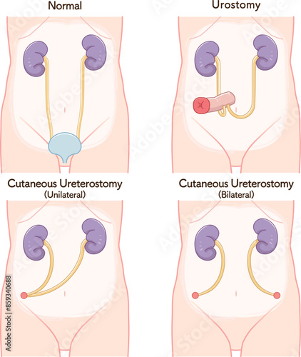 尿路ストーマ、ストーマ、ウロストミー、urostomy、オストメイト、大腸、小腸、膀胱、イラスト、illustration