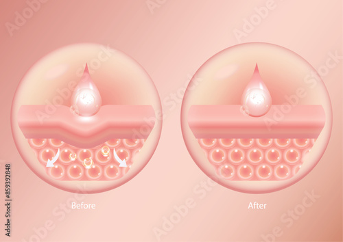 before and after administering hyaluronic acid serum, improves sagging skin and tightens the skin