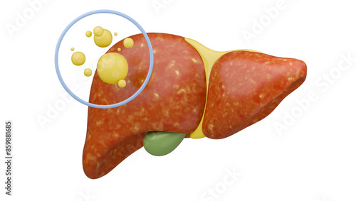 3D Fatty Liver Disease photo