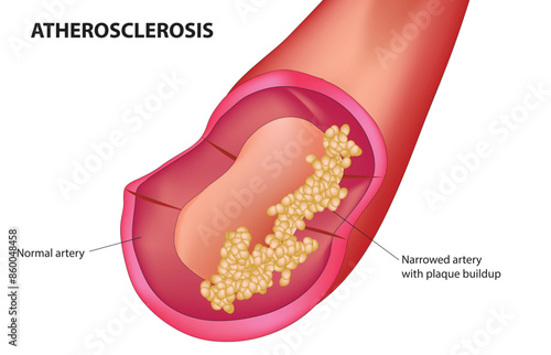Atherosclerosis is a medical condition characterized by the buildup of plaque inside arteries. This buildup consists of fats, cholesterol, calcium, and other substances found in the blood. 