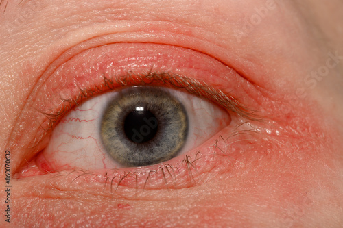 Zaczerwieniona skóra wokół oka, nużeniec infekcja skóry twarzy  photo