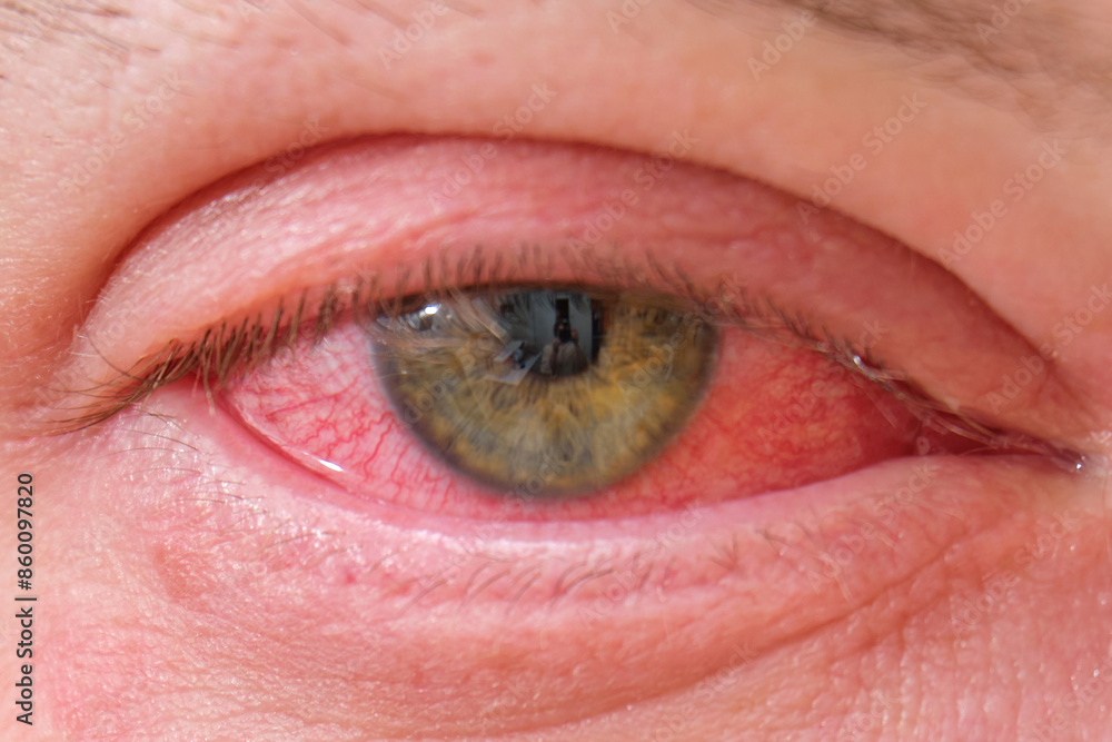 Obraz premium The red eye of a man with conjunctivitis, viral infection with redness of the eyeball protein