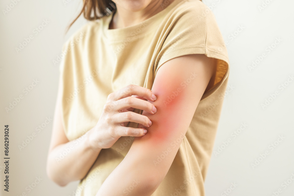 custom made wallpaper toronto digitalDermatology asian young woman, girl allergy, allergic reaction from atopic, insect bites on her arm, hand in scratching itchy, itch red spot or rash of skin. Healthcare, treatment of beauty.