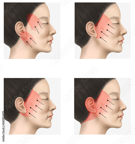 Fotografía facelift