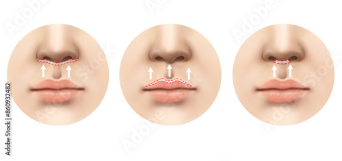 philtrum