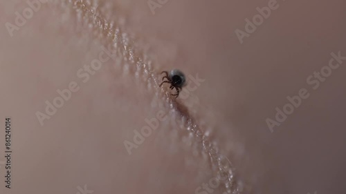 A tick on the skin that transmits dangerous diseases such as tick-borne encephalitis or Lyme disease.