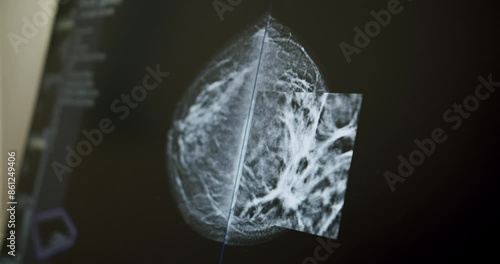 Closeup handheld shot of mammogram of breast on computer monitor during cancer examination in laboratory of modern clinic. high-performance Mammography device in a modern hospital.