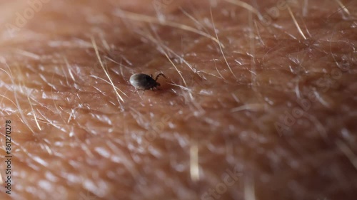 A tick on the skin that transmits dangerous diseases such as tick-borne encephalitis or Lyme disease.
