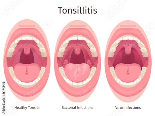 Tonsils. Human sore throat airways inflammation tonsil lymph and tongue in open mouth, bacteria swollen glands pharyngitis tonsillolith disease symptom, swanky illustration