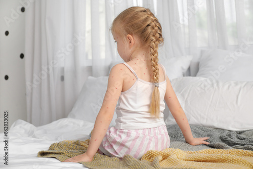 Obraz na plátně Little girl ill with chickenpox sitting in bedroom, back view