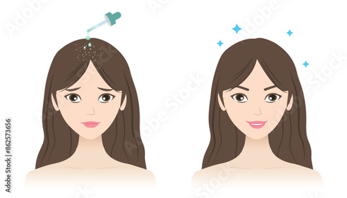 Before and after anti dandruff treatment vector illustration isolated on white background. The woman with dandruff, white dry flakes, scaly scalp and healthy hair. Hair care and problem concept.