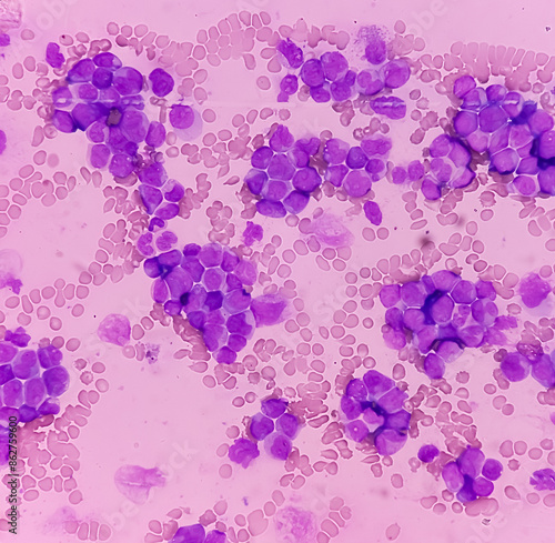Acute myeloid leukemia (AML). Smear show monocytes and mostly blast cell. Anemia and thrombocytopenia. Most common acute leukemia affecting adults.