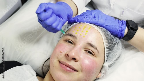 Cosmetologist preparing for fractional microneedle mesotherapy facial rejuvenation procedure, applying serum from a syringe on forehead. Peeling, woman face skin regeneration, dermapen microneedling