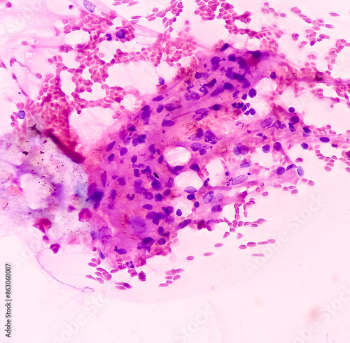 Photomicrograph of Osteolytic lesion of left proximal radium, Positive for malignant cell, small blue round cell tumor, ewing's sarcoma, PNET, metastatic carcinoma. photo