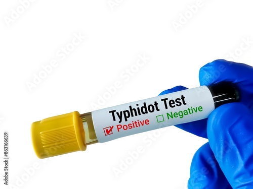 Εκτύπωση καμβά Blood sample for Typhidot test, to detect IgG and IgM antibodies for typhoid fev