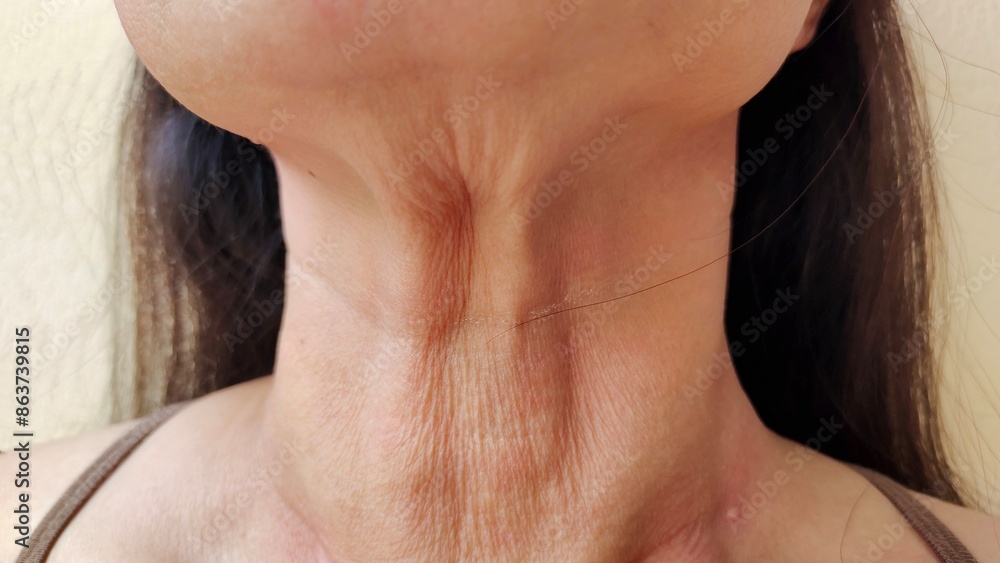 Portrait the wrinkle and Flabby skin under the chin, neck wattle and Flabbiness, wrinkly and loose, the crease and dermatologist on the body of middle aged women, health care and beauty concept. Portrait the wrinkle and Flabby skin under the chin, neck wattle and Flabbiness, wrinkly and loose, the crease and dermatologist on the body of middle aged women, health care and beauty concept.