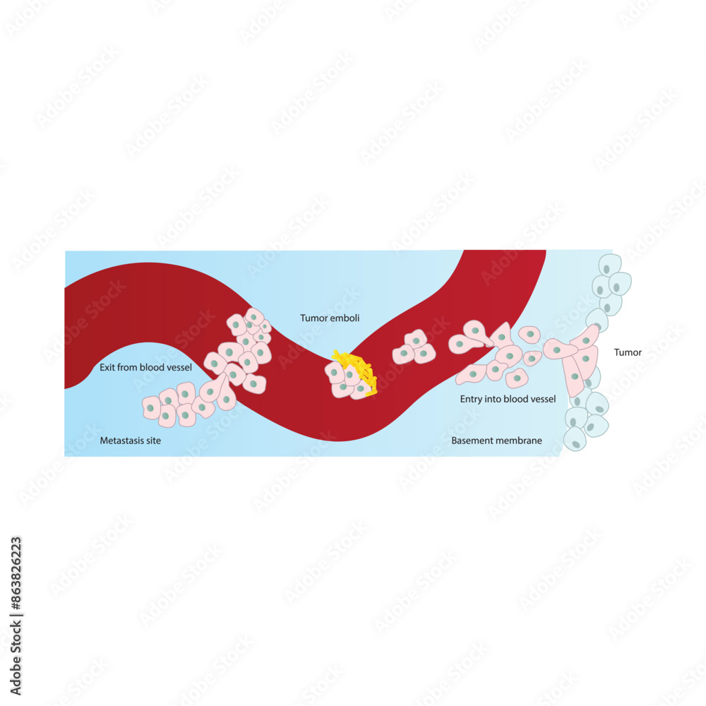 Diagram showing the formation of metastasis via blood vessel ...