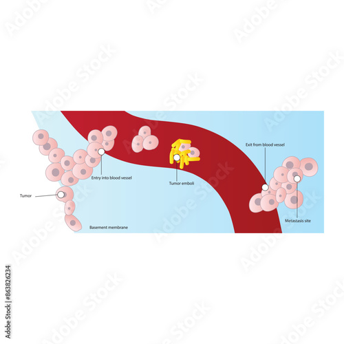 Diagram showing the formation of metastasis via blood vessel - metastatic process of a tumor, schematic scientific diagram.