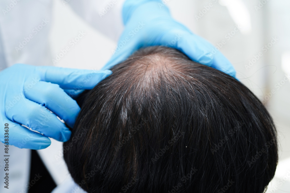 Doctor touch bold head in man, hair loss treatment health problem. Doctor touch bold head in man, hair loss treatment health problem.