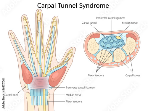 anatomy of carpal tunnel syndrome, highlighting the median nerve, flexor tendons, and carpal bones diagram hand drawn schematic vector illustration. Medical science educational illustration