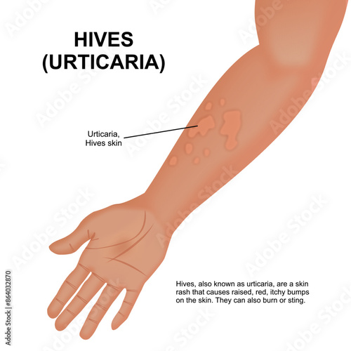 Hives Urticaria in hand illustration
