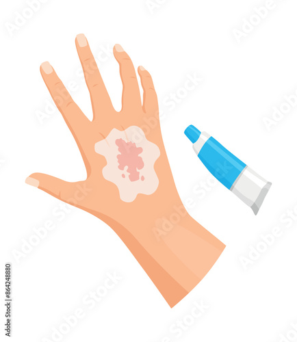Hands injured skin and procedures of wound cleaning. First aid for wound. Medicine cure or treatment. First emergency help for human hand trauma