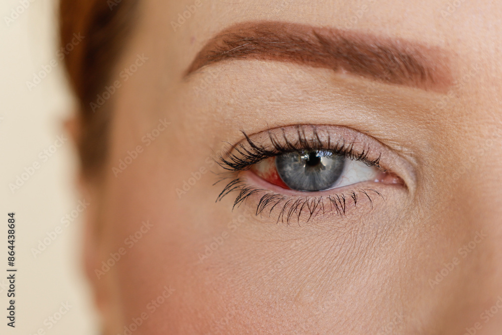 Obraz premium Blue eye on the right side of a woman, without identifying the person, with ocular hemorrhage, highlighting the red bleeding in this eye.